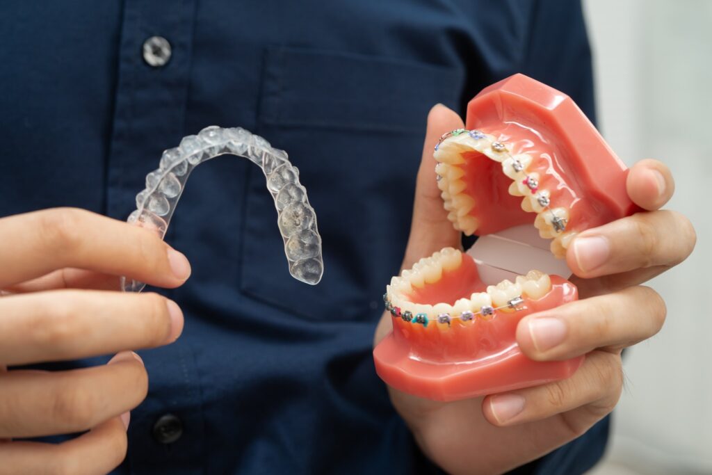 Aligner-Schiene und Kiefermodell mit fester Zahnspange im Vergleich